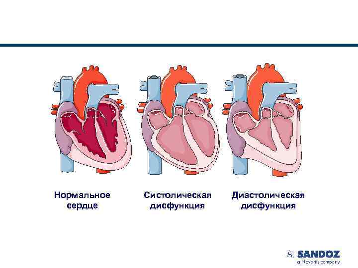 Нормальное сердце Систолическая дисфункция Диастолическая дисфункция 