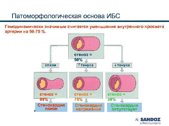 Патоморфологическая основа ИБС Гемодинамически значимым считается уменьшение внутреннего просвета артерии на 50 -75 %.