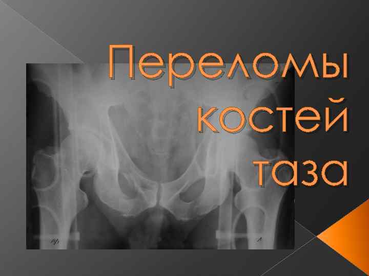 Переломы костей таза 