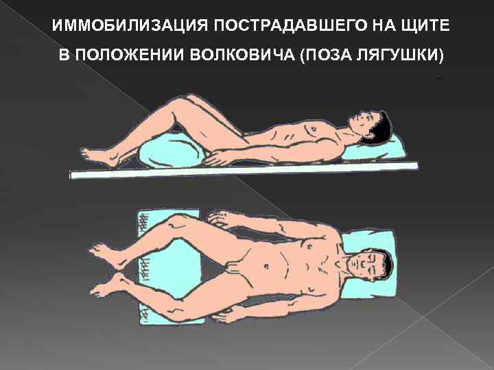 ИММОБИЛИЗАЦИЯ ПОСТРАДАВШЕГО НА ЩИТЕ В ПОЛОЖЕНИИ ВОЛКОВИЧА (ПОЗА ЛЯГУШКИ) 