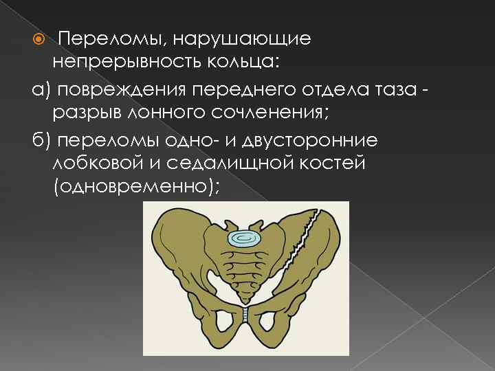 Переломы, нарушающие непрерывность кольца: а) повреждения переднего отдела таза разрыв лонного сочленения; б) переломы