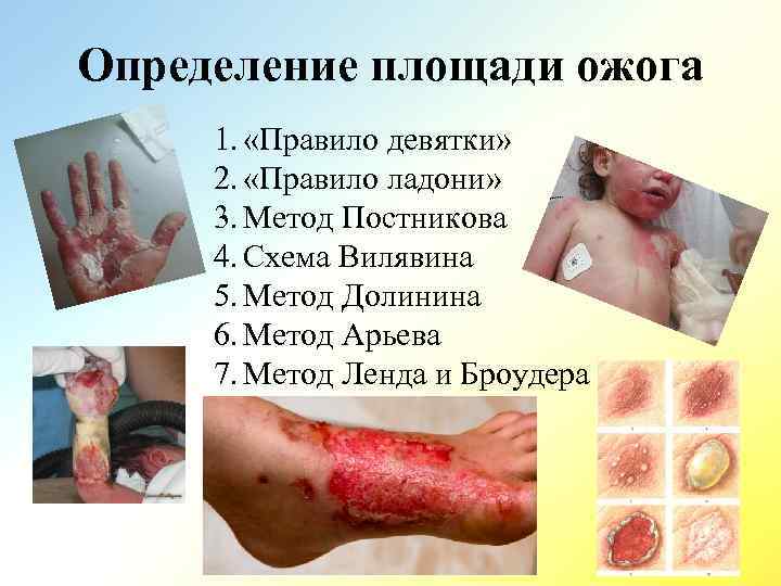Определение площади ожога 1. «Правило девятки» 2. «Правило ладони» 3. Метод Постникова 4. Схема