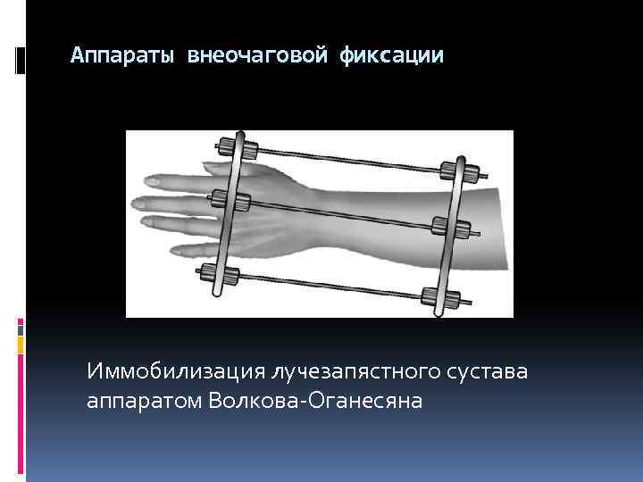 Аппараты внеочаговой фиксации Иммобилизация лучезапястного сустава аппаратом Волкова-Оганесяна 