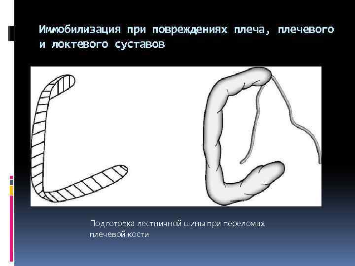 Иммобилизация при повреждениях плеча, плечевого и локтевого суставов Подготовка лестничной шины при переломах плечевой