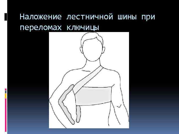 Иммобилизация ключицы. Иммобилизация плеча. Иммобилизация руки полой кителя.