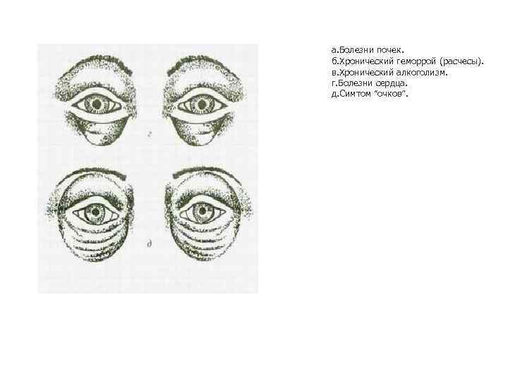а. Болезни почек. б. Хронический геморрой (расчесы). в. Хронический алкоголизм. г. Болезни сердца. д.