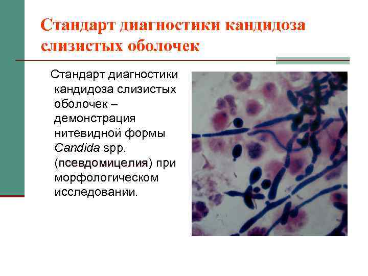 Стандарт диагностики кандидоза слизистых оболочек – демонстрация нитевидной формы Candida spp. (псевдомицелия) при псевдомицелия