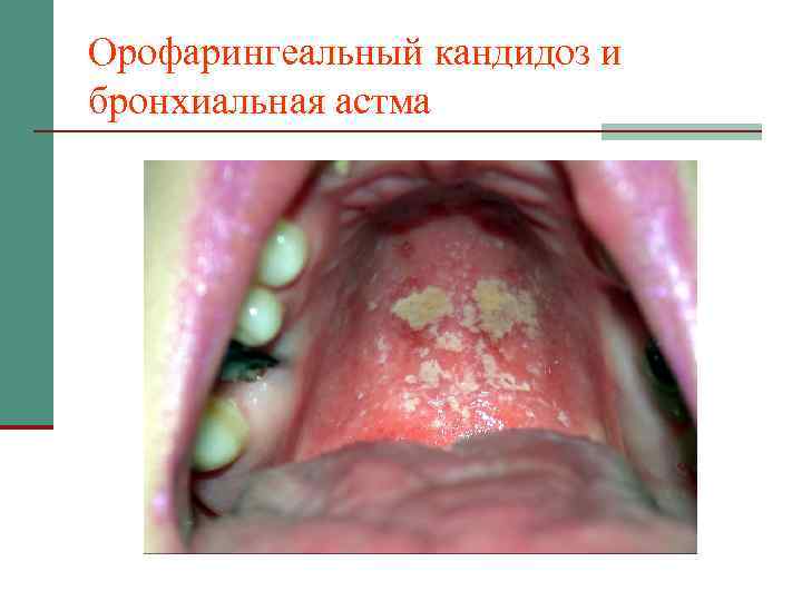 Орофарингеальный кандидоз и бронхиальная астма 