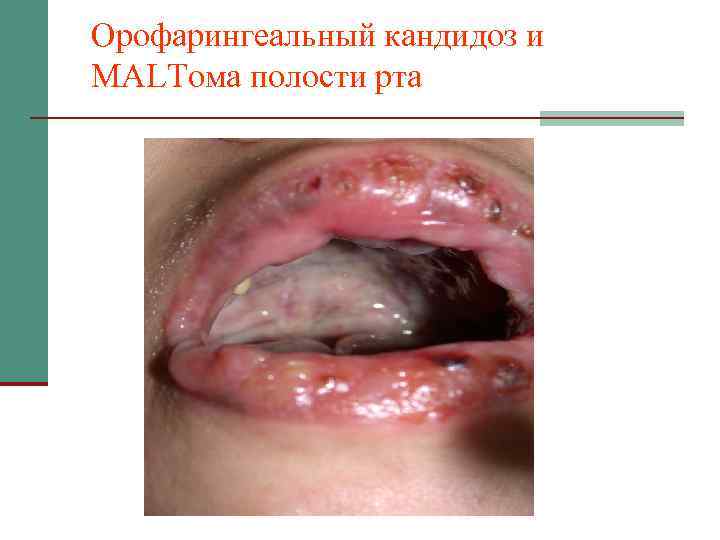 Орофарингеальный кандидоз и MALTома полости рта 