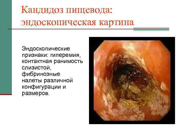 Кандидоз пищевода: эндоскопическая картина Эндоскопические признаки: гиперемия, контактная ранимость слизистой, фибринозные налеты различной конфигурации