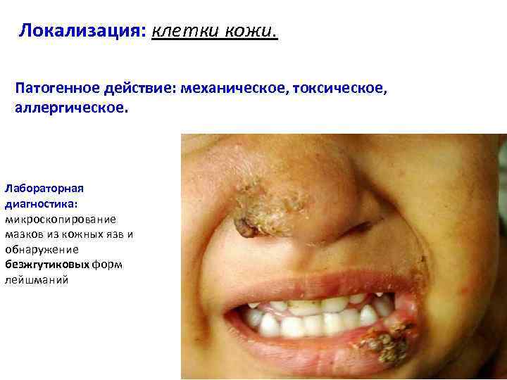 Локализация: клетки кожи. Патогенное действие: механическое, токсическое, аллергическое. Лабораторная диагностика: микроскопирование мазков из кожных