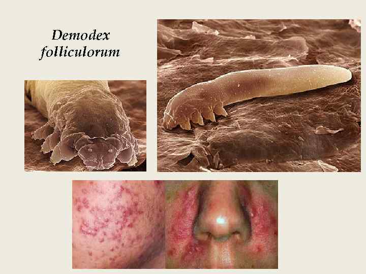 Demodex folliculorum 