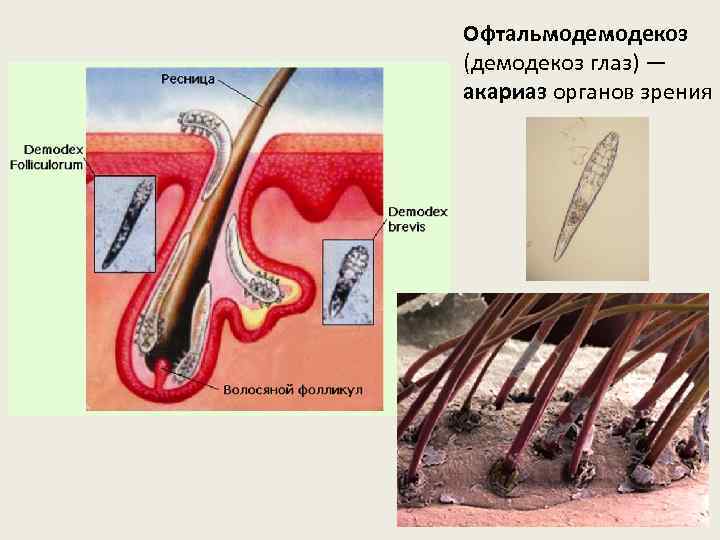 Офтальмодекоз (демодекоз глаз) — акариаз органов зрения 