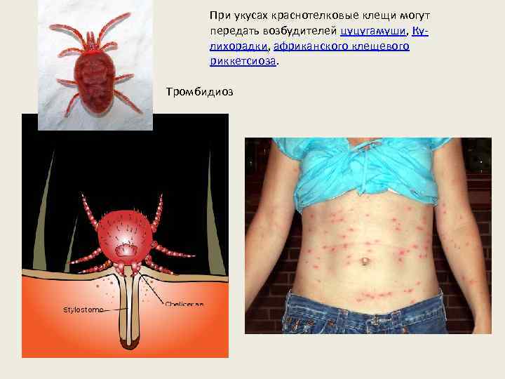 При укусах краснотелковые клещи могут передать возбудителей цуцугамуши, Кулихорадки, африканского клещевого риккетсиоза. Тромбидиоз 