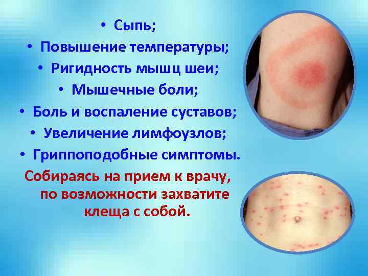  • Сыпь; • Повышение температуры; • Ригидность мышц шеи; • Мышечные боли; •