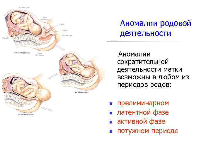 Аномалии родовой деятельности Аномалии сократительной деятельности матки возможны в любом из периодов родов: n