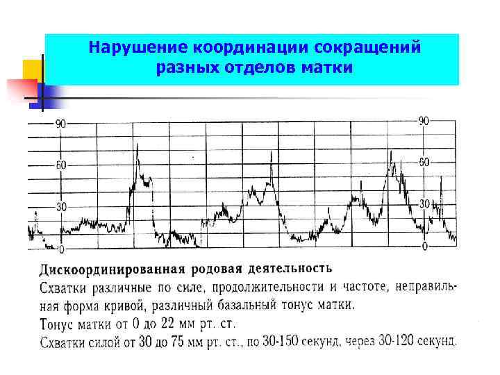 Сокращение матки. Дискоординированная родовая деятельность партограмма. Партограмма дискоординации родовой деятельности. Дискоординированная родовая деятельность КТГ. Дискоординация родовой деятельности на КТГ.