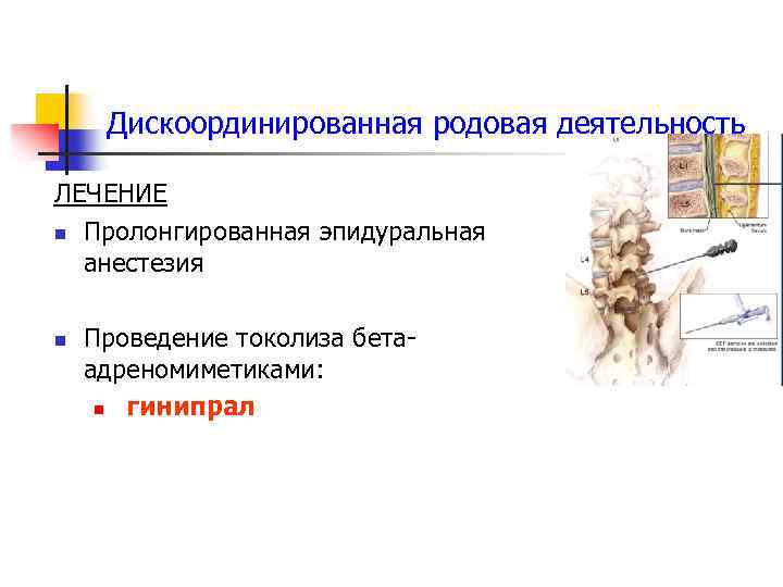 Дискоординированная родовая деятельность ЛЕЧЕНИЕ n Пролонгированная эпидуральная анестезия n Проведение токолиза бетаадреномиметиками: n гинипрал