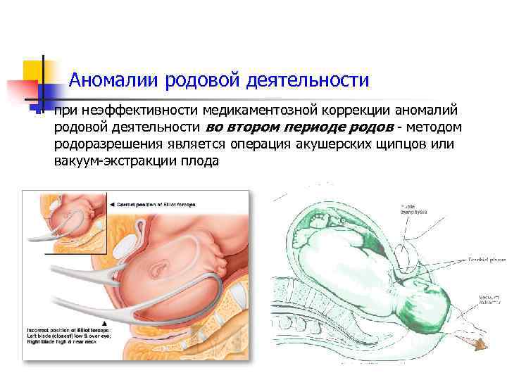 Аномалии родовой деятельности n при неэффективности медикаментозной коррекции аномалий родовой деятельности во втором периоде