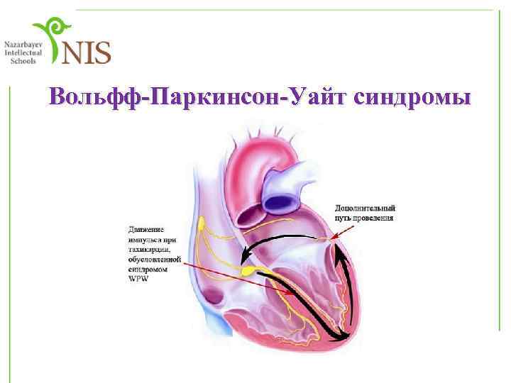 Вольфф-Паркинсон-Уайт синдромы 