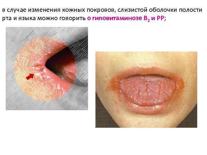 в случае изменения кожных покровов, слизистой оболочки полости рта и языка можно говорить о