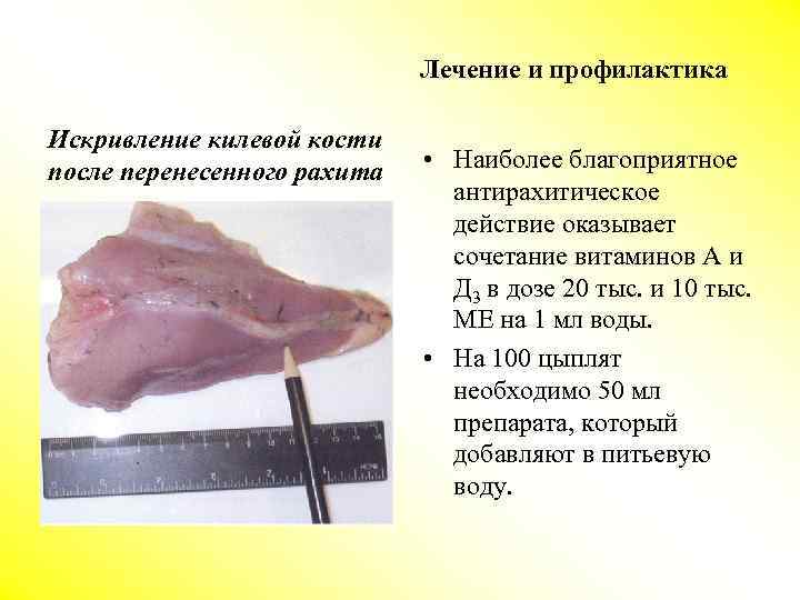 Лечение и профилактика Искривление килевой кости после перенесенного рахита • Наиболее благоприятное антирахитическое действие
