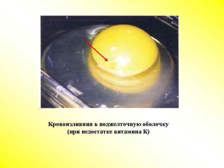 Кровоизлияния в поджелточную оболочку (при недостатке витамина К) 