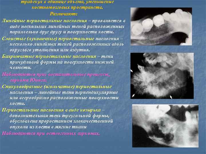 трабекул в единице объема, уменьшение костномозговых пространств. Различают: Линейные периостальные наслоения – проявляется в