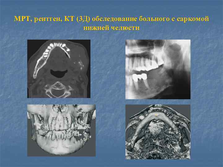 МРТ, рентген, КТ (3 Д) обследование больного с саркомой нижней челюсти 