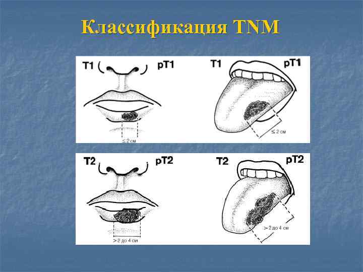 Классификация TNM 