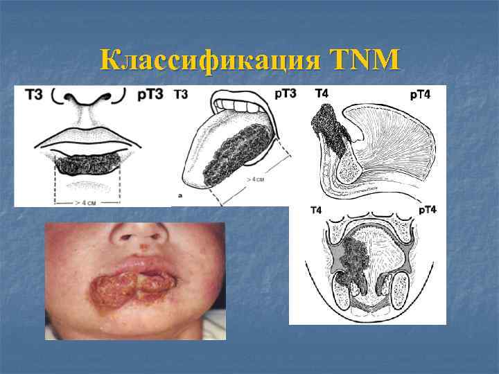 Классификация TNM 
