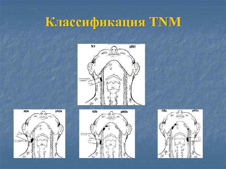 Классификация TNM 
