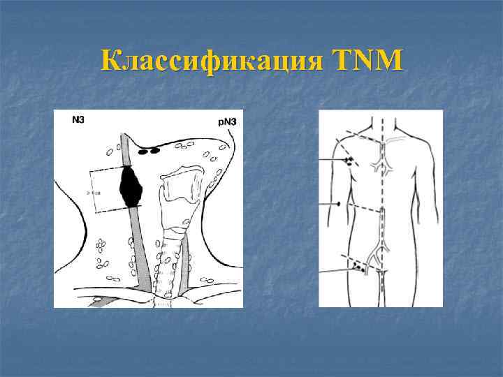 Классификация TNM 