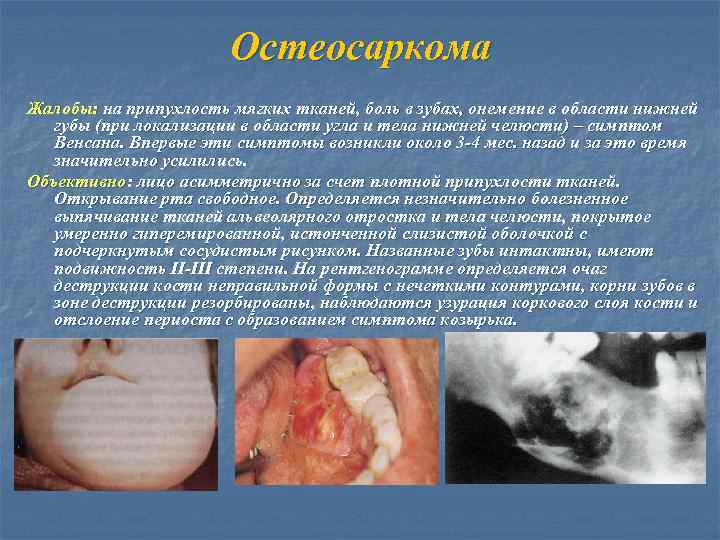 Остеосаркома Жалобы: на припухлость мягких тканей, боль в зубах, онемение в области нижней губы