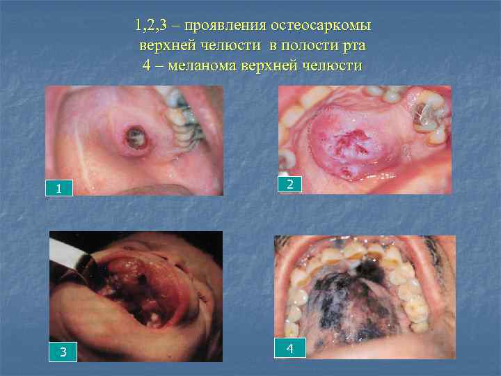 1, 2, 3 – проявления остеосаркомы верхней челюсти в полости рта 4 – меланома