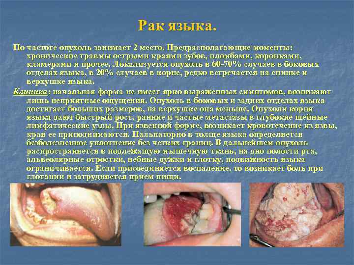 Рак языка. По частоте опухоль занимает 2 место. Предрасполагающие моменты: хронические травмы острыми краями