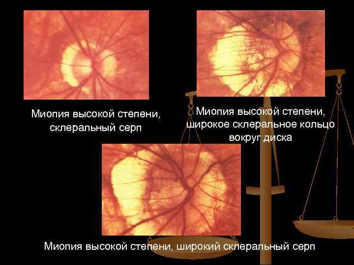 Миопия высокой степени, склеральный серп Миопия высокой степени, широкое склеральное кольцо вокруг диска Миопия