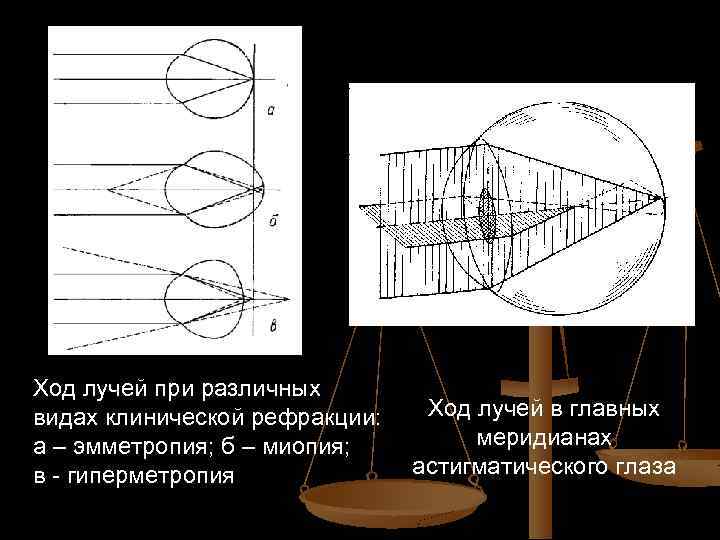 Ход лучей при различных видах клинической рефракции: а – эмметропия; б – миопия; в