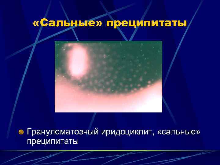  «Сальные» преципитаты Гранулематозный иридоциклит, «сальные» преципитаты 