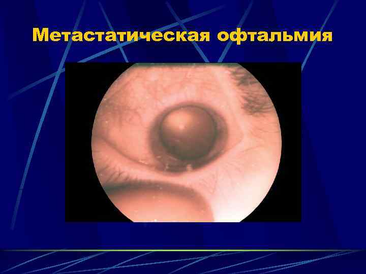 Метастатическая офтальмия 