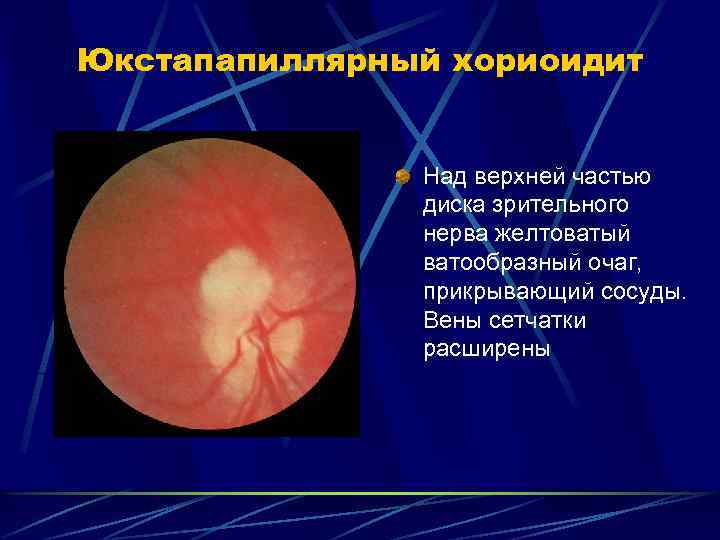 Юкстапапиллярный хориоидит Над верхней частью диска зрительного нерва желтоватый ватообразный очаг, прикрывающий сосуды. Вены