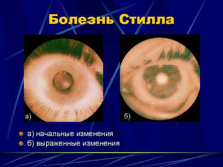 Презентация болезнь стилла