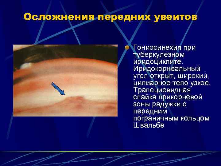 Осложнения передних увеитов Гониосинехия при туберкулезном иридоциклите. Иридокорнеальный угол открыт, широкий, цилиарное тело узкое.