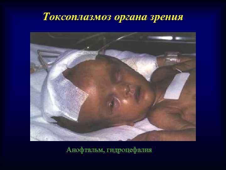Токсоплазмоз органа зрения Анофтальм, гидроцефалия 