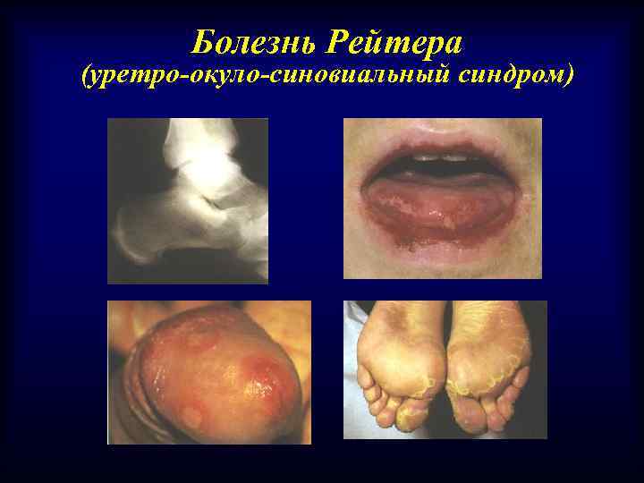 Болезнь Рейтера (уретро-окуло-синовиальный синдром) 