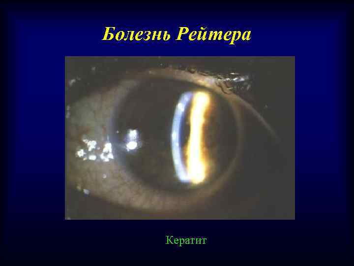 Болезнь Рейтера Кератит 