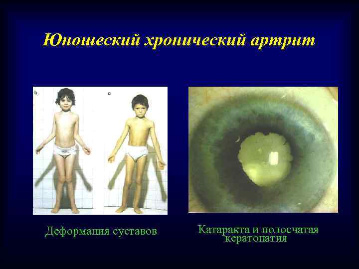 Юношеский хронический артрит Деформация суставов Катаракта и полосчатая кератопатия 