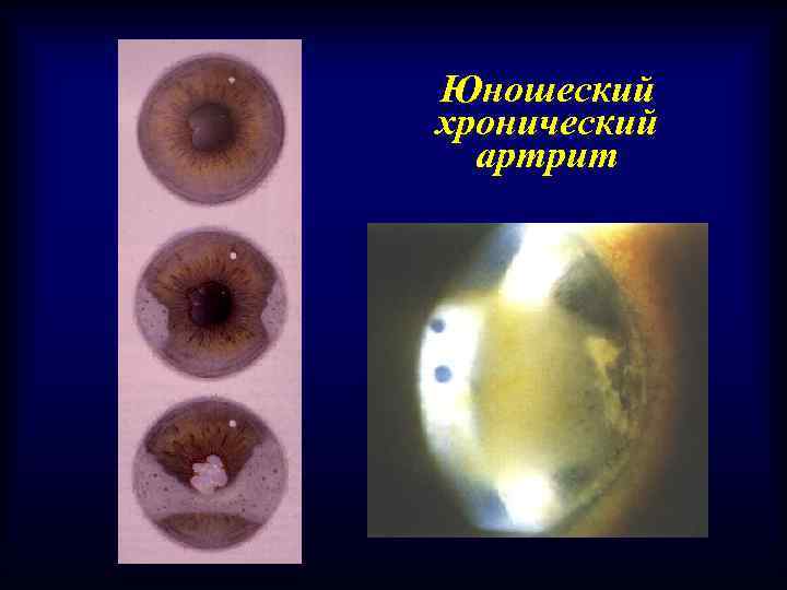 Юношеский хронический артрит 