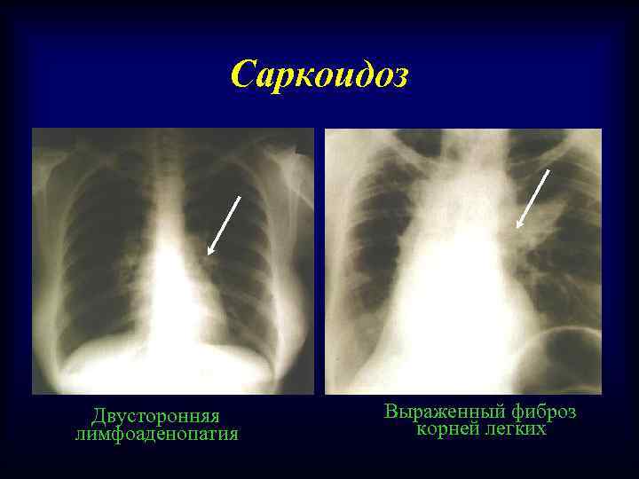 Саркоидоз Двусторонняя лимфоаденопатия Выраженный фиброз корней легких 