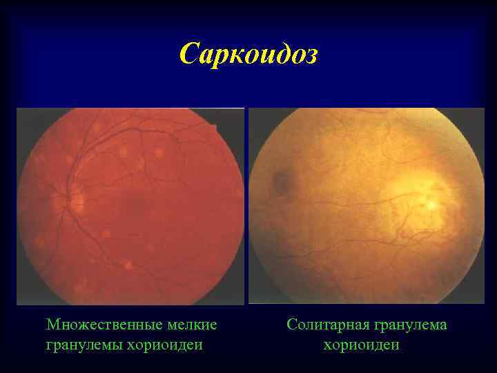 Саркоидоз Множественные мелкие гранулемы хориоидеи Солитарная гранулема хориоидеи 